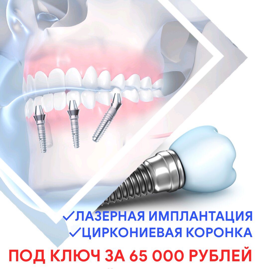 препарирование зубов лазером. лазерная имплантация зубов. лазерная имплантация зубов. лазер в пародонтологии. стоматологический лазер в работе.