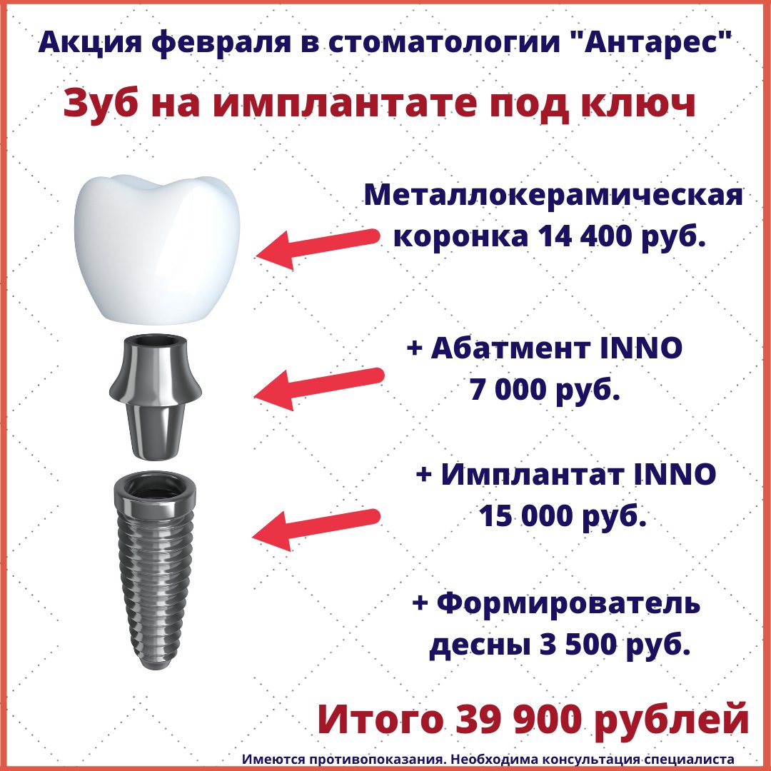 Импланты в воронеже. Имплантация под ключ.