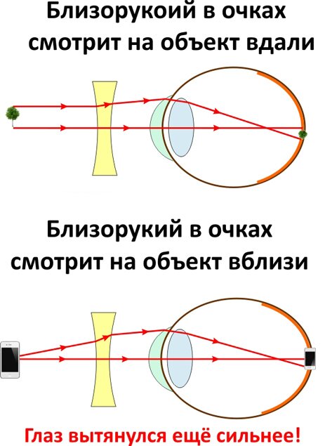 Какие очки нужны дальнозорким людям. Укажите очковые линзы для коррекции косоглазия.