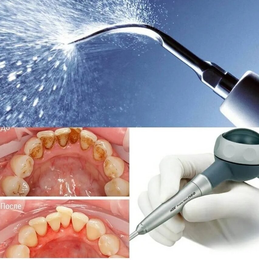 Картинки профессиональная гигиена полости рта