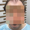 фото от пользователя Клементий  в отзыве о клинике пересадки волос GGmed