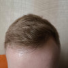 фото от пользователя Иван Бородин в отзыве о клинике пересадки волос FUE Clinic