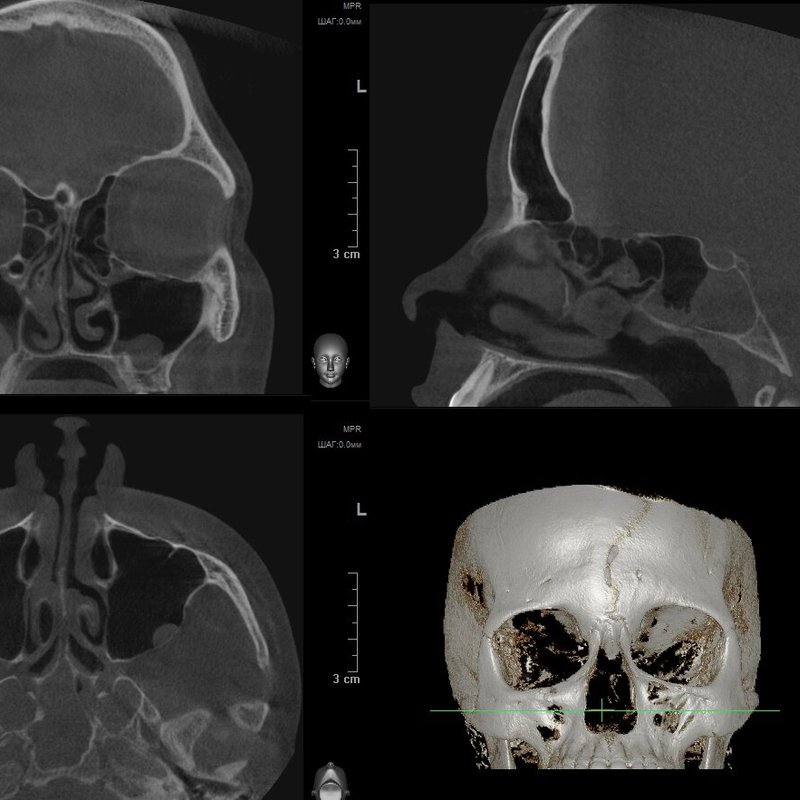Кт придаточных пазух. Компьютерная томография ЛОР органов. Рентгеновская кт ЛОР органов. Кт в оториноларингологии. Патология ЛОР органов на кт.
