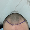 фото от пользователя Андрей в отзыве о клинике пересадки волос FUE Clinic