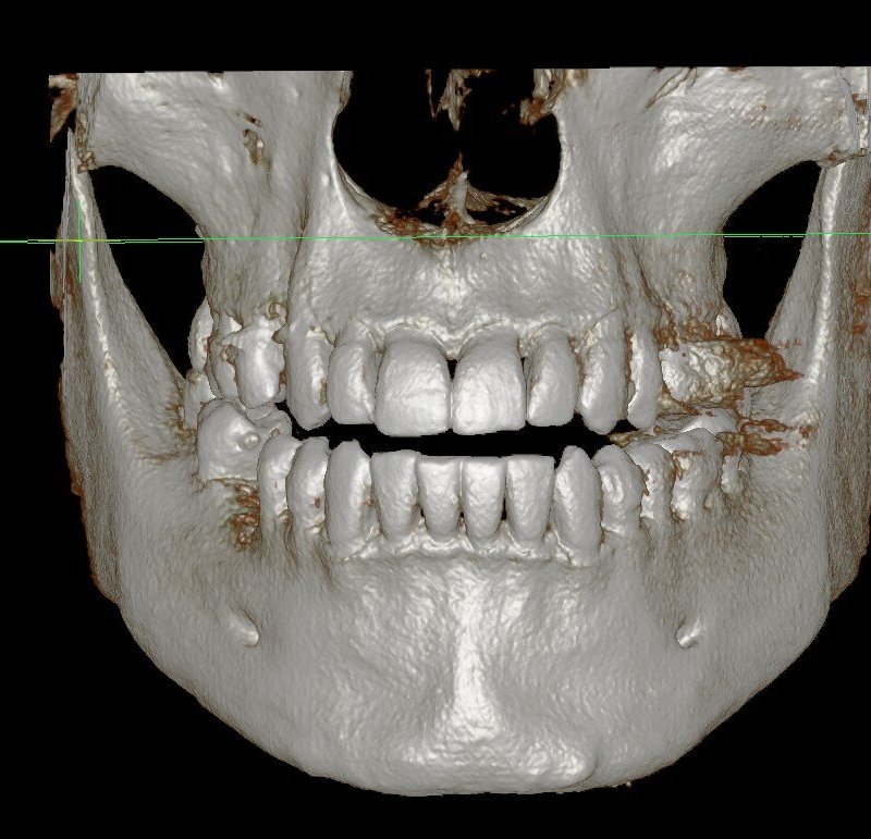 Кт челюсти. Компьютерная томография челюсти 12х8.5.