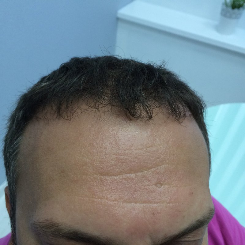 фотография работы Клиники пересадки волос FUE Clinic