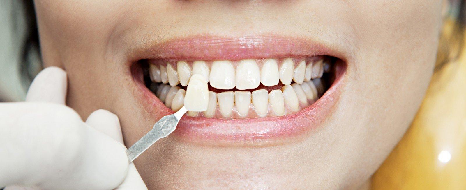 Эстетическая реставрация зубов - Ваша безупречная внешность!