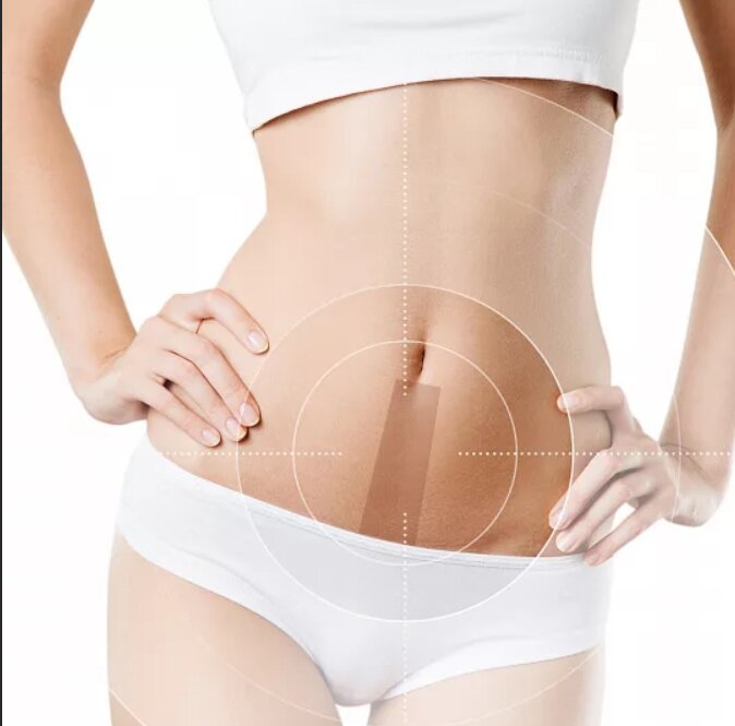 Белая линия живота лазерная. Эпиляция линии живота. Лазерная эпиляция полоска на животе. Эпиляция линии живота. Эпиляция линии живота.